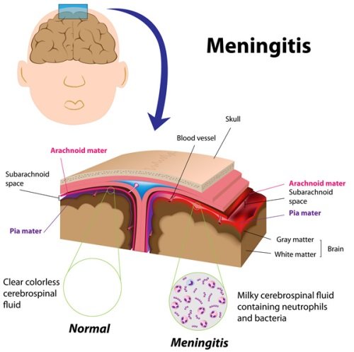 Структура менингита