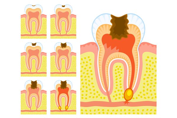 периодонтит